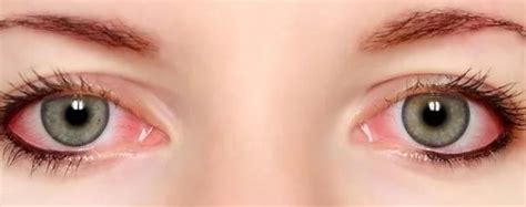 怎么改善红血丝眼睛，保持眼部卫生／补充足够的水分／使用眼部保湿产品