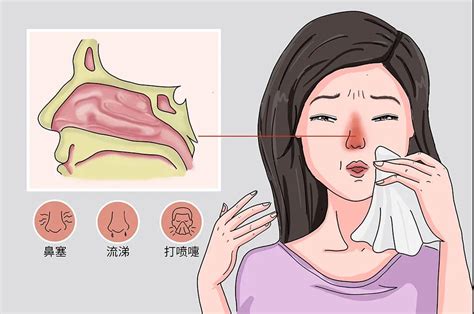 过敏性鼻炎的症状有哪些表现及治疗方法，症状表现／治疗方法